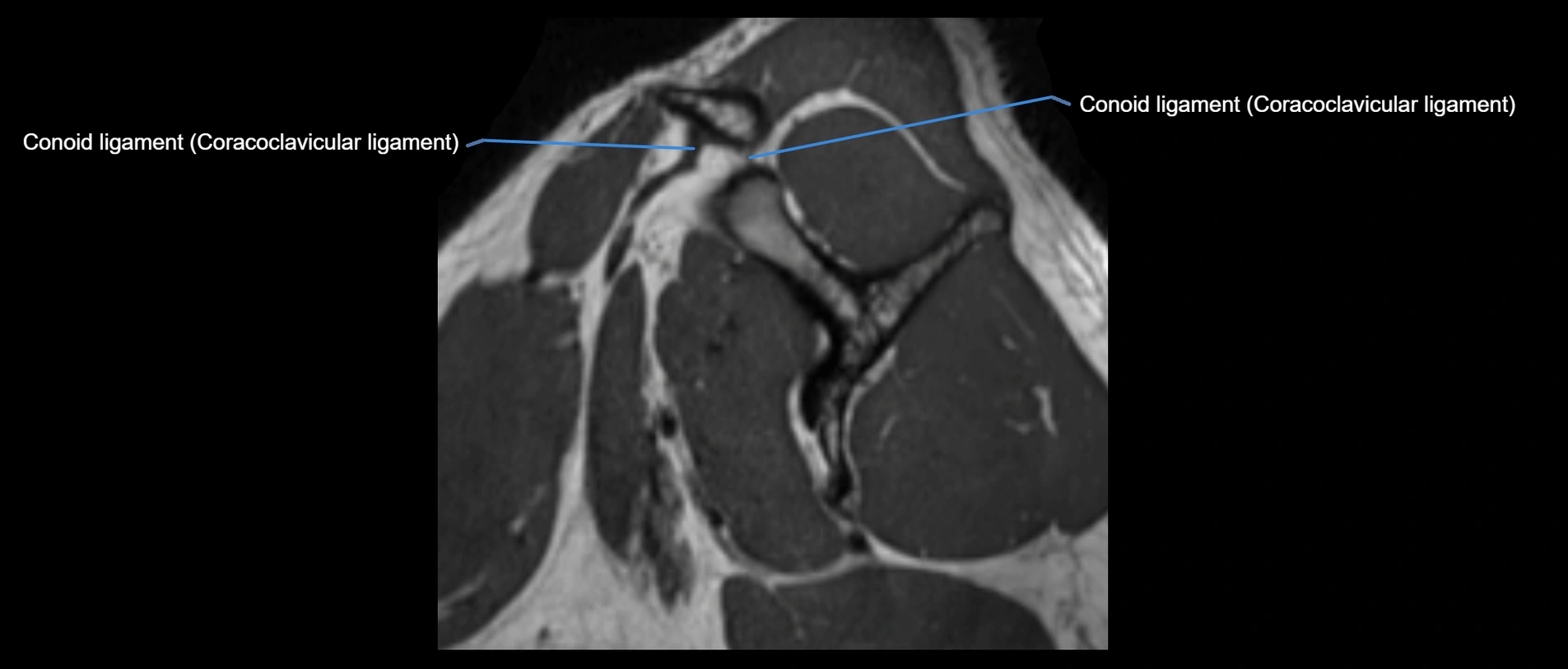 shoulder ligaments sagittal  cross sectional anatomy 3T MRI AI enhanced radiology image -img-00001-00013.webp